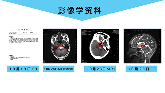 脑出血护理个案分析PPT模板_第10页PPT效果图