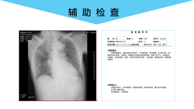 脑出血护理个案分析PPT模板_第11页PPT效果图